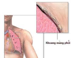 Viêm màng phổi  - Hình ảnh minh họa